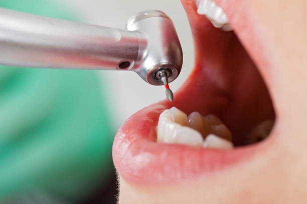 Best Emergency Tooth Extraction in Forest Meadows, CA